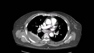 Radiology Rounds  radRoundscom A Radiologist Auntminnie  CT Pulmonary Embolism [upl. by Buddy703]