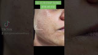 Full Face Mesotherapy TREATMENT BEFORE AND AFTER [upl. by Eiramlatsyrc]