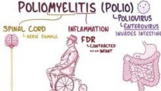 Poliomyelitis  Introduction of poliomyelitis  Causes of poliomyelitis  Type of poliomyelitis [upl. by Spearing]