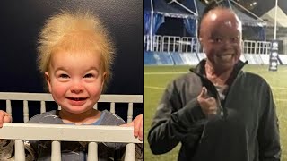 Uncombable Hair Syndrome and Other Rare Genetic Conditions [upl. by Norabel]