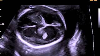 Hydrocephalus stenosis of the cerebral aqueduct [upl. by Nicram]