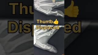 Xray Thumb👍 radiologycareer radiologist medicalimaging doctor radiology medicaltest anatomy [upl. by Deva]