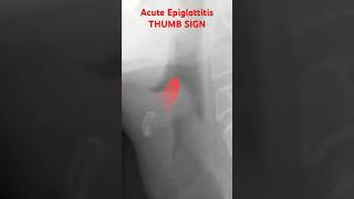 Acute Epiglottitis Thumb sign [upl. by Kirrad]