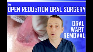 HOW TO REMOVE A MOUTH STD  ORAL WART SURGICAL REMOVAL [upl. by Aracaj]