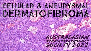 Cellular Dermatofibroma amp Aneurysmal Dermatofibroma 101 pathology dermpath dermatology [upl. by Treborsemaj]