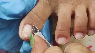 ingrown toenail removal 😱 [upl. by Nirehtak]