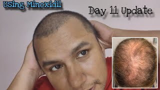 Minoxidil for 18 year old  Day 11 Update  Hair Growth Thickness amp Texture Changes  Hindi [upl. by Eirroc]