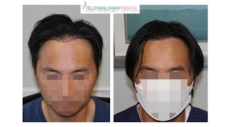 Asian American Hair Transplant Repair  Feller amp Bloxham Medical  NY NYC Long Island [upl. by Farrish]