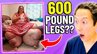 Plastic Surgeon Reacts to MY 600 Lb LIFE How to Lose 600 Lb Legs [upl. by Vikki]