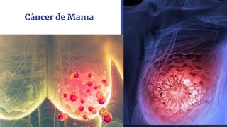 Cáncer de Mama Anatomía básica Concepto Clasificación Detección Temprana y Diagnóstico [upl. by Hitchcock]