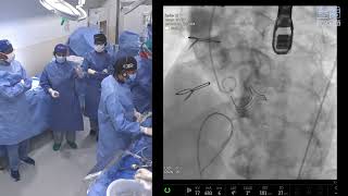 ValveinValve TAVR for degenerated Magna Valve using Evolut Fx Valve Live Relay  10102024 [upl. by Ankeny]