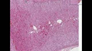 Histopathology AdrenalCortical adenoma [upl. by Nicolis]