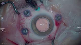 Retinal detachment Lukan Mishev live stream [upl. by Wales]