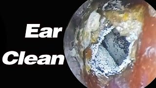 Ear Picking The Earwax Is So Big Its Blocking The Ear Canal I Cant Hear AnythingASMRearwax [upl. by Reube]