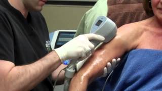 Exilis for Skin Tightening on a Womans Arms with Dr Seiler [upl. by Refanej982]