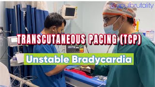 Emergency transcutaneous pacing TCP in unstable bradycardia [upl. by Pack]