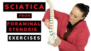 Sciatica from foraminal stenosis  exercises [upl. by Ralina]