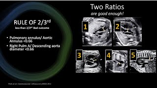 Assessment of Severity of TOF on Fetal Echo [upl. by Atkinson]