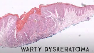 Warty Dyskeratoma acantholytic dyskeratosis pathology dermpath dermatology dermatopathology [upl. by Arimas900]