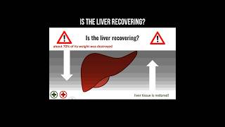 Is the liver recovering cirrhosis liver transplante livercirrhosis [upl. by Fabiano]