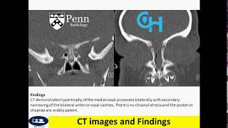 Congenital nasal pyriform aperture stenosis Newborn with respiratory distress [upl. by Wiltz]