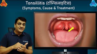 Tonsillitis  Home Remedies amp Treatment  Symptoms amp Causes of Tonsillitis By Dr Puspendra [upl. by Daly]