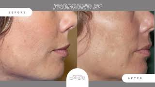 Before amp After Profound RF Microneedling [upl. by Morril282]