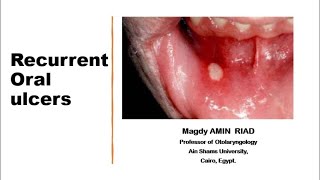 II Recurrent Oral Ulcers [upl. by Anastasio]