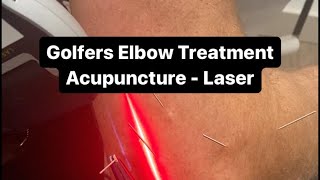 Golfers Elbow Treatment Celina Acupuncture  Laser [upl. by Nevins]