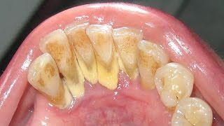 Worlds Worst Teeth Tartar Removal amp Treatment [upl. by Abraham]