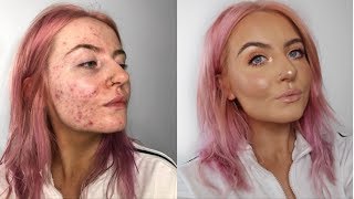 LETS TALK ACNE  ACCUTANE  GET READY WITH ME  ABBIE BULL [upl. by Osugi]