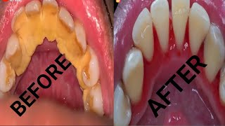 Teeth tartar remove [upl. by Aridatha474]