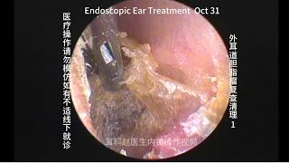 Re examination and cleaning of external auditory canal cholesteatoma 20241031 [upl. by Sielen]