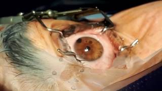 Corneal tattoo for laser peripheral iridotomy [upl. by Repotsirhc509]