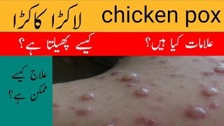 What is Chickenpox  What are Causes Signs Diagnosis and Treatment of Chicken pox in UrduHindi [upl. by Kip345]