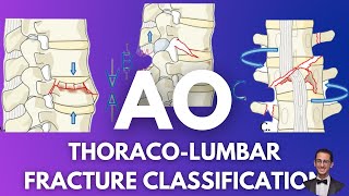 AO Classification Thoracolumbar Fractures [upl. by Gussy]