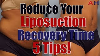 Liposuction Recovery Care  Reduce Your Liposuction Surgery Recovery Time  5 Tips [upl. by Fidelas]