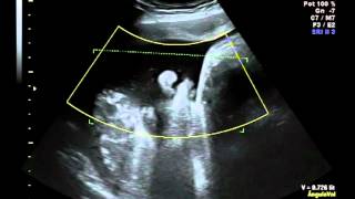 Ecografía Obstétrica 4D  Dexeus Mujer [upl. by Yrbua]