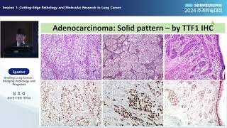 2024 대한흉부종양외과학회 추계학술대회 강의영상 Session 11 Grading Lung Cancer  Bridging Pathology and Prognosis [upl. by Areehs]