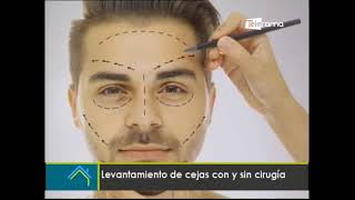 Estética al Día Levantamiento de cejas con y sin cirugía [upl. by Namzaj]