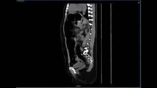 Sigmoid Volvulus Sagittal CT JETem 2018 [upl. by Retnuh]