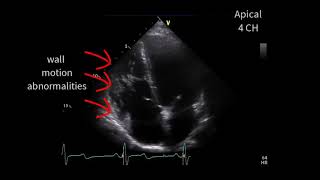 A special cardiomyopathy [upl. by Drawe]