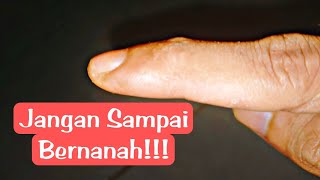 Cara Mengatasi Jari Tangan Atau Kaki Yang Cantengan [upl. by Namsu]