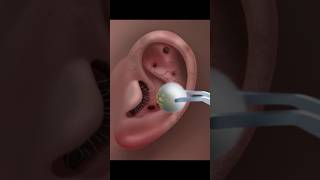 ASMR Ear Cleaning amp Treatment for Ultimate Relaxation asmr satisfying animation tretment [upl. by Mokas]