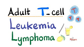 Adult T cell Leukemia  Lymphoma  Human Tcell Leukemia Virus HTLV1  Oncology [upl. by Michelina793]