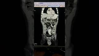 GASTROENTEROLOGY  Identify the spot diagnosis in given CECT ABDOMEN clip [upl. by Kemppe]