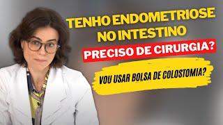 Tenho endometriose no intestino Preciso de cirurgia Vou usar bolsa de colostomia [upl. by Anahc519]