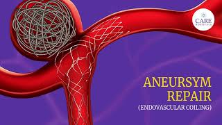 Aneurysm Repair  Endovascular Coiling  CARE Hospitals [upl. by Sama127]