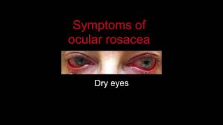 Ocular Rosacea [upl. by Aivatal634]