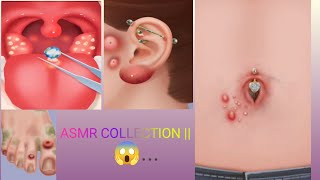 ASMR Body treatment surgery navel ston ingrown nail ear cleaning tonsil stone removalasmr [upl. by Nohsyar]